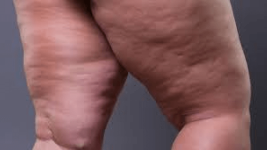 Tratamento para lipedema em Barretos: alívio e melhora da qualidade de vida na Clínica Vitaliza. Saiba mais sobre opções e preços!
