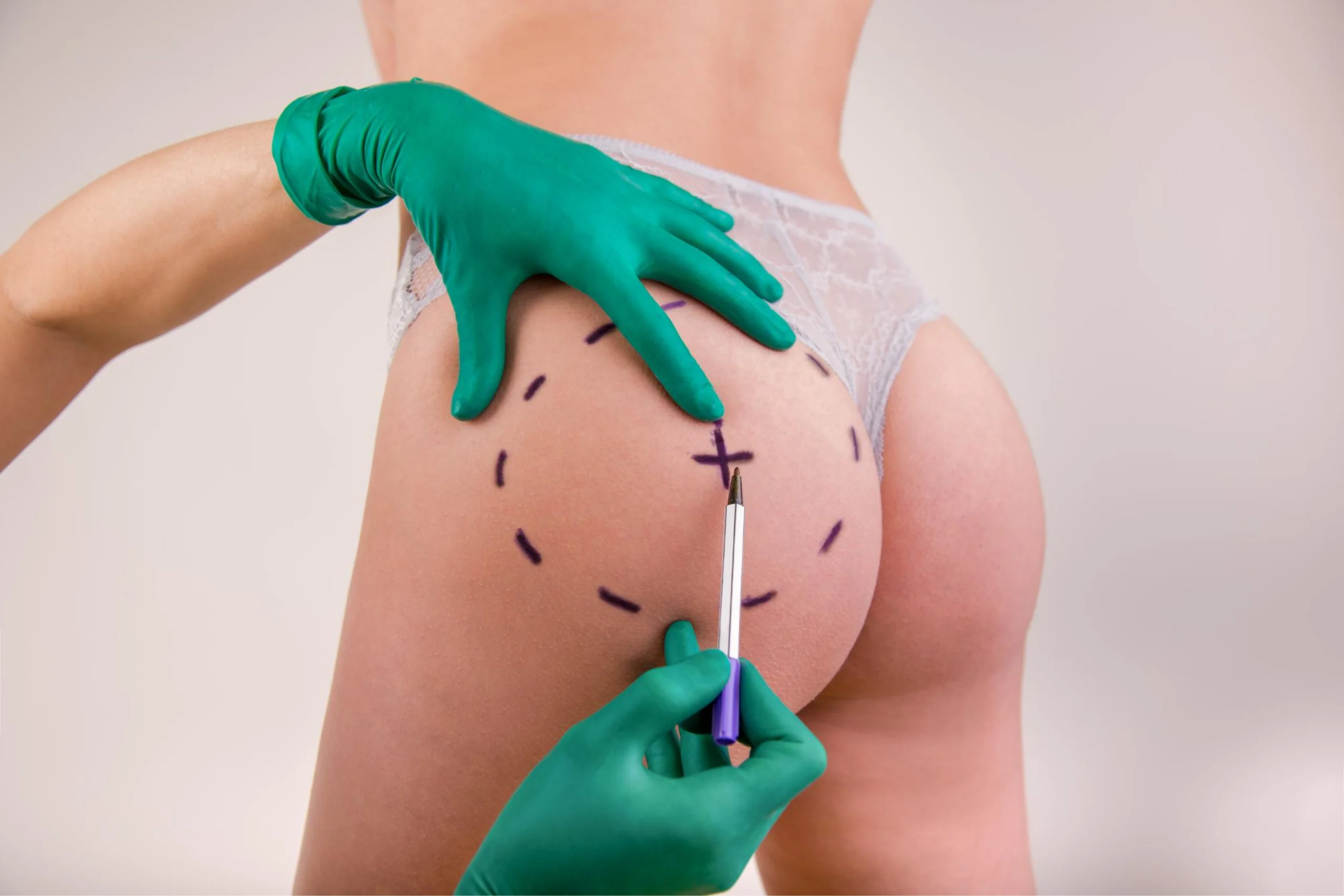 Harmonização de Glúteos - V2 Clínica Vitaliza | Estética, Beleza e Saúde