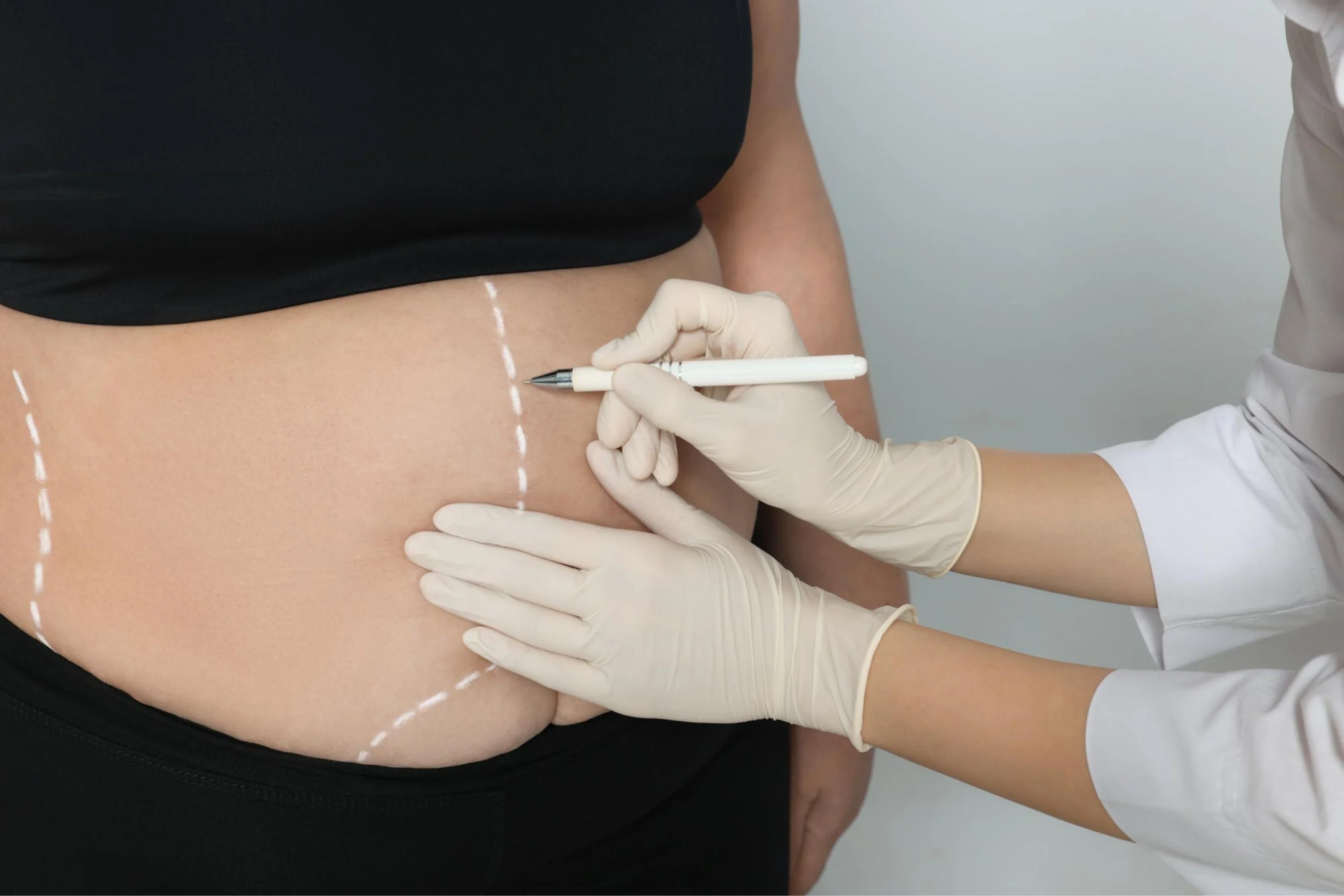 Bioplastia de Glúteos - V2 Clínica Vitaliza | Estética, Beleza e Saúde