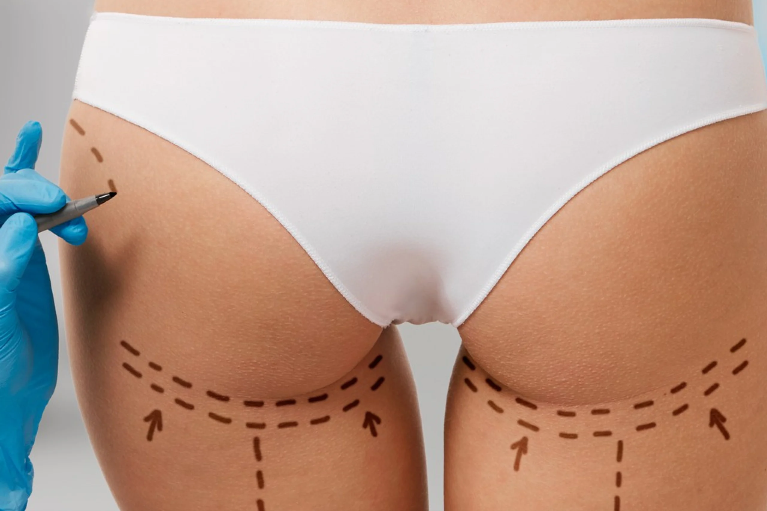 Bioplastia de Glúteos - V2 Clínica Vitaliza | Estética, Beleza e Saúde