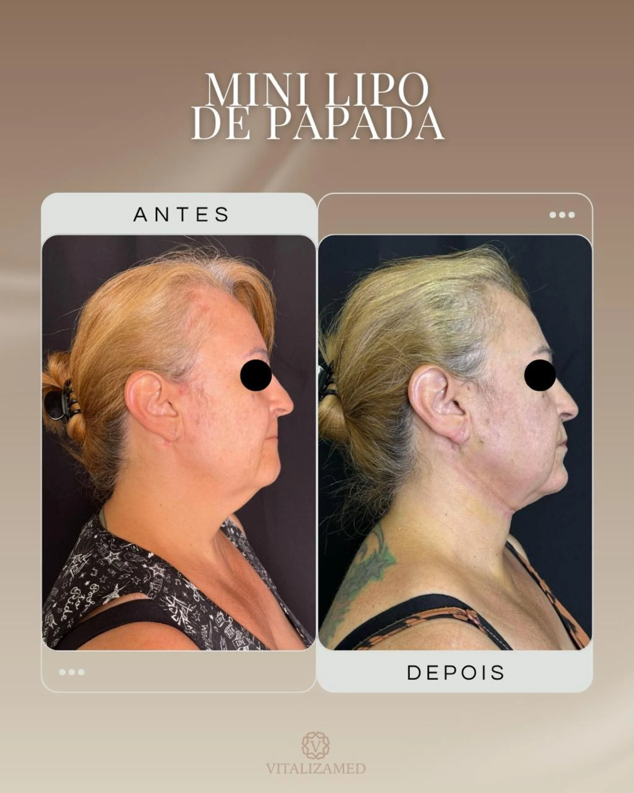 Mini Lipo em Barretos Clínica Vitaliza | Estética, Beleza e Saúde arte 1