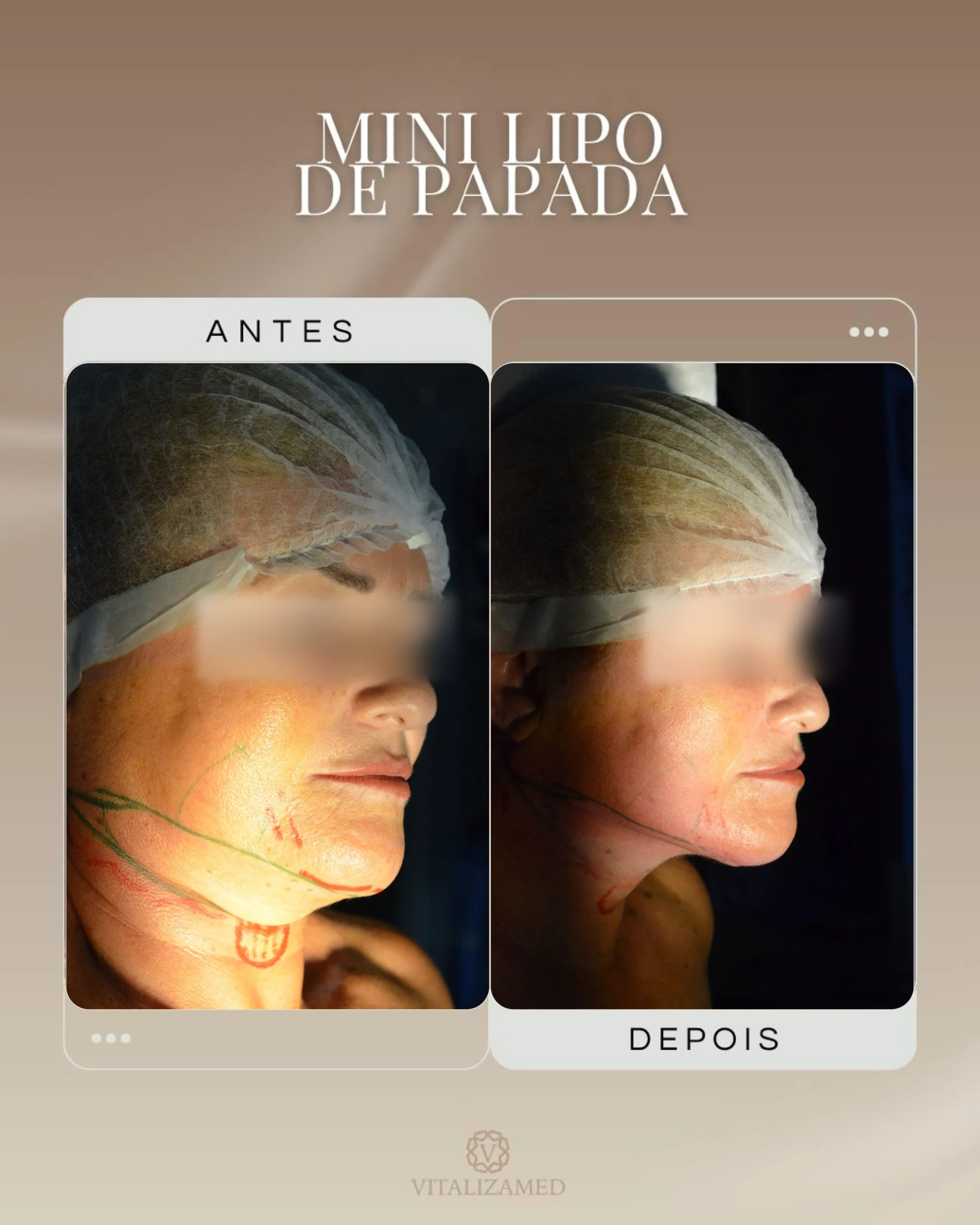 Mini Lipo em Barretos Clínica Vitaliza | Estética, Beleza e Saúde arte 2