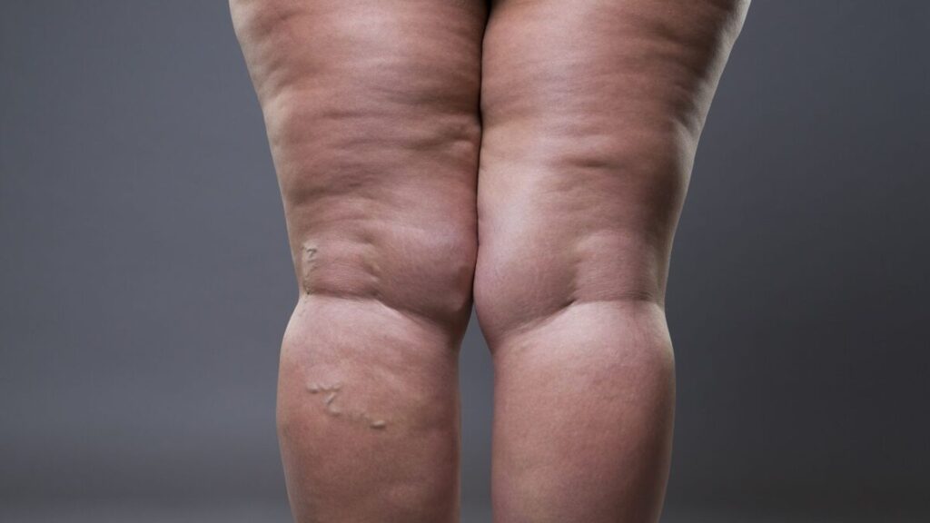 Lipedema: Diferença Entre Inchaço Comum e Doença Clínica Vitaliza | Estética, Beleza e Saúde A Clínica Vitaliza está à disposição para ajudá-lo a entender melhor sua condição e encontrar o tratamento ideal.
