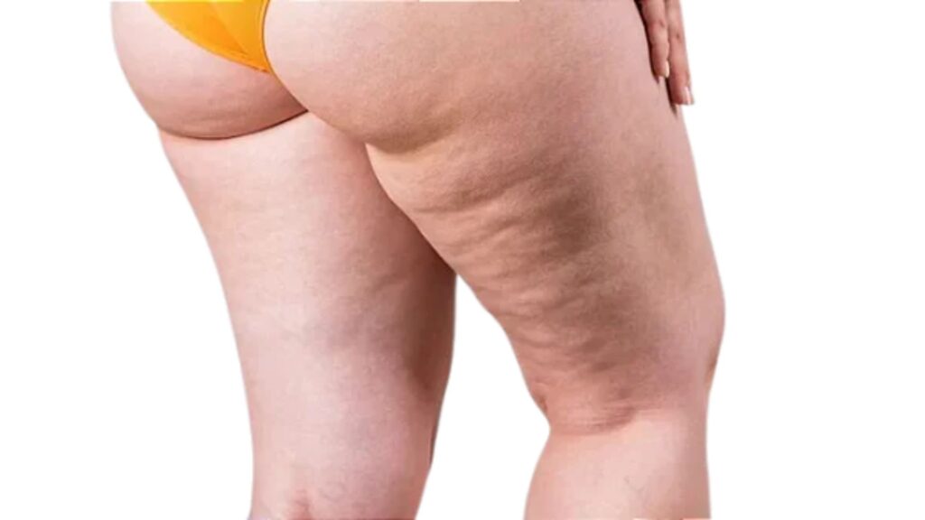 Lipedema: Alimentação, Terapias e Protocolo Integrado de Tratamento Clínica Vitaliza | Estética, Beleza e Saúde Descubra como a alimentação e terapias integradas podem ajudar no tratamento do lipedema na Clínica Vitaliza com Dr Vagner Chiapetti.