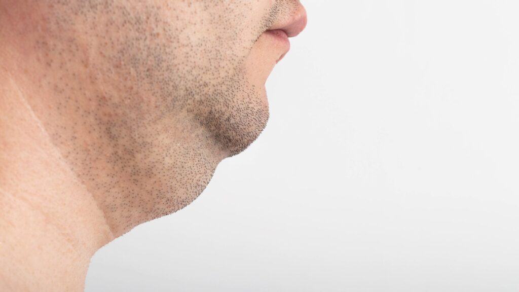 Minilipo de Papada: Quanto Custa e o Que Influencia no Preço Clínica Vitaliza | Estética, Beleza e Saúde Minilipo de Papada: Quanto Custa e o Que Influencia no Preço