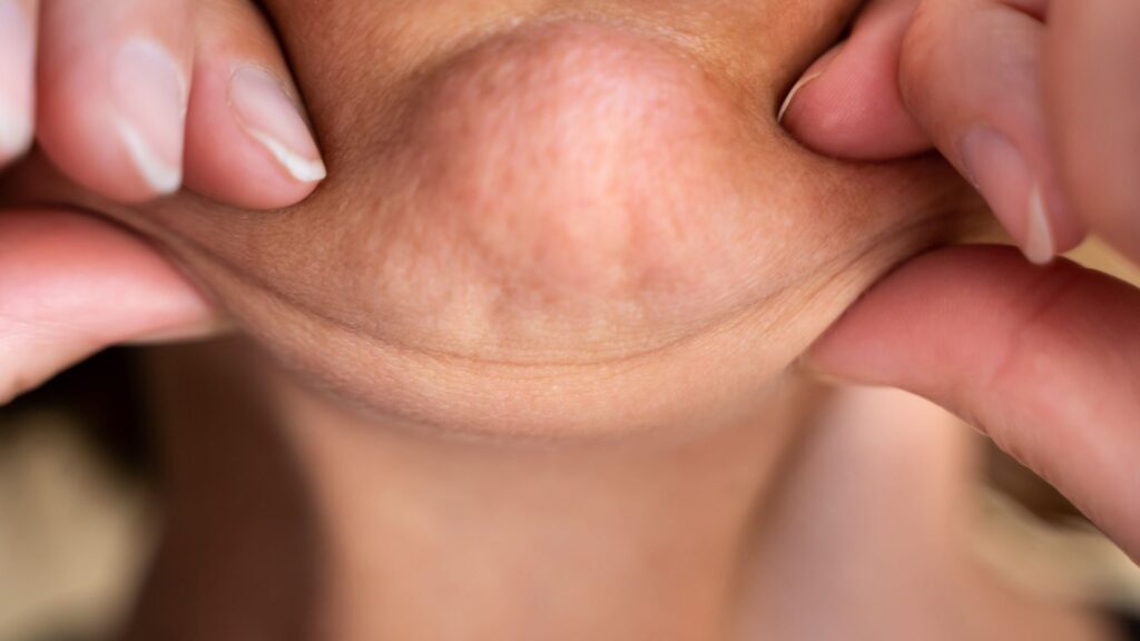 Minilipo de Papada: Perfil do Paciente Ideal Para o Procedimento Clínica Vitaliza | Estética, Beleza e Saúde Descubra se você é o paciente ideal para a minilipo de papada com o Dr. Vagner Chiapetti na Clínica Vitaliza em Barretos, SP.